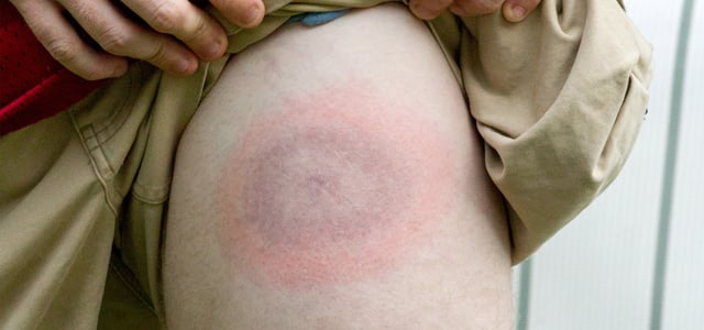 a close up image of a thigh with lyme disease