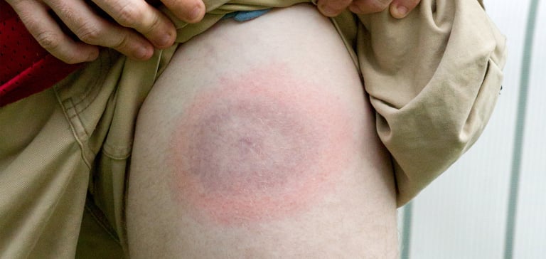 a close up image of a thigh with lyme disease