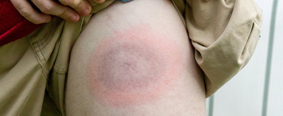 a close up image of a thigh with lyme disease